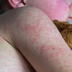 Measles cases in Mexico spike after week of rapid spread