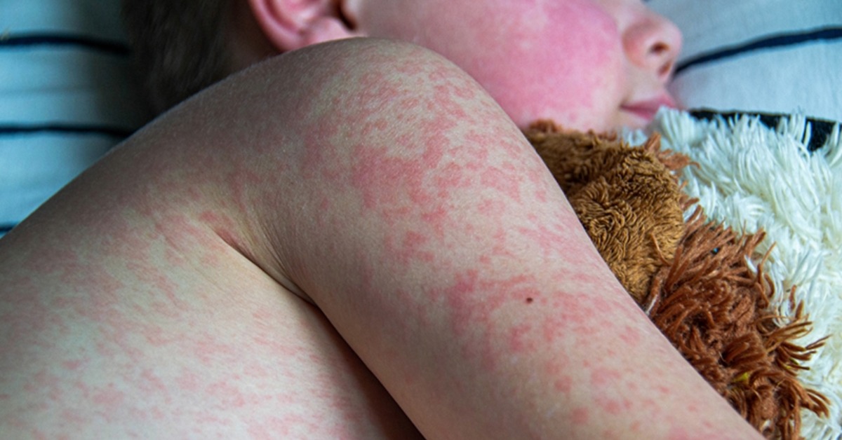 Measles cases in Mexico spike after week of rapid spread