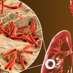 Tuberculosis Cases Rise Early in Baja California Sur