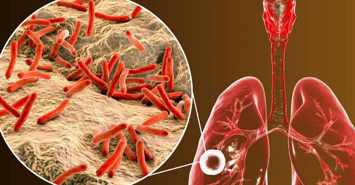 Tuberculosis Cases Rise Early in Baja California Sur